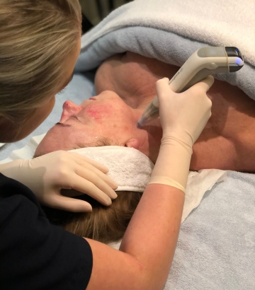 Skin Needling