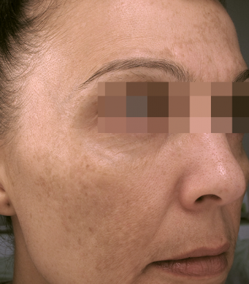 A woman with Pigmentation and melasma. 